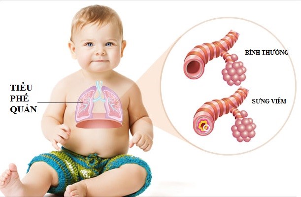  Trẻ bị viêm phế quản và viêm phổi tái phát thường do vi khuẩn, virut.
