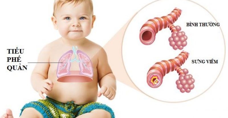  Trẻ sơ sinh bị viêm tiểu phế quản do vi khuẩn hoặc virut.