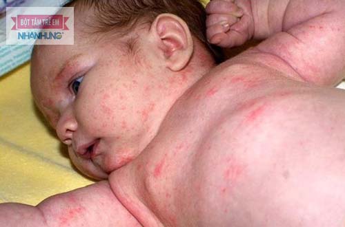 Bệnh sởi ở trẻ do virus gây nên