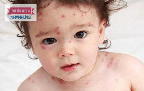 Cần cách li trẻ bị thủy đậu với người nhà