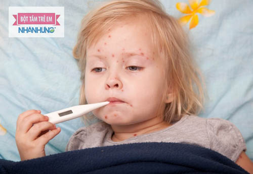 Trẻ là đối tượng dễ bị thủy đậu nhất