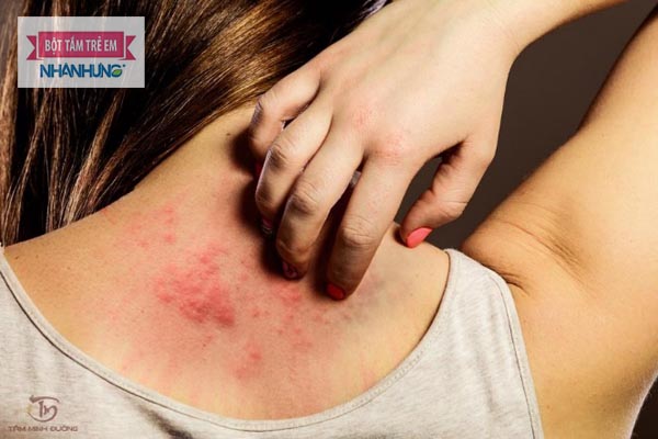 Sẩn phù và ngứa là 2 dấu hiệu điển hình của bệnh mề đay
