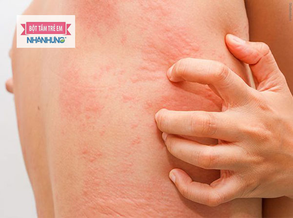 Bệnh mề đay là bệnh lý phổ biến bất cứ ai cũng có thể mắc phải