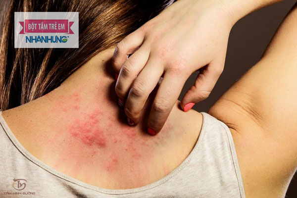 Bị nổi mề đay vào buổi tối gây ảnh hưởng nghiêm trọng tới giấc ngủ