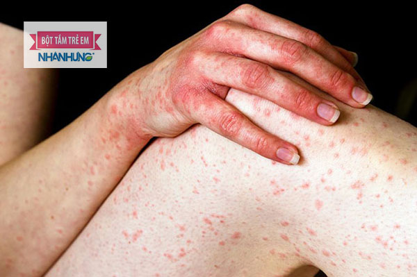 Mề đay là bệnh lý ngoài da thường xuyên tái phát