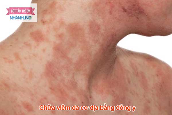 Viêm da cơ địa là bệnh mạn tính, không thể điều trị dứt điểm