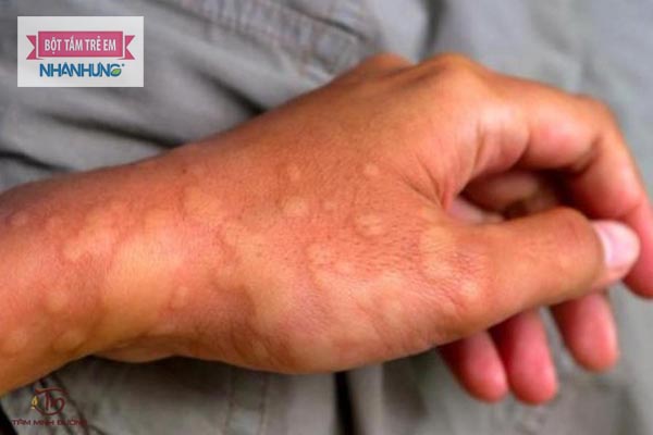 Mề đay do virus, ký sinh trùng 