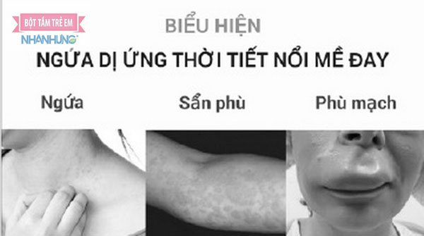 Dấu hiệu điển hình của dị ứng thời tiết nổi mề đay