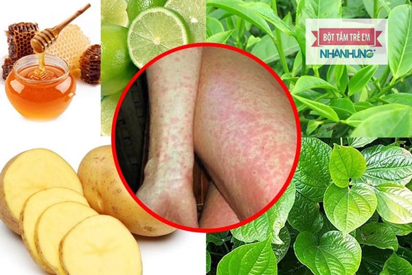 Khoai tây, chanh mật ong hay lá khế đều có tác dụng giảm triệu chứng của dị ứng thời tiết