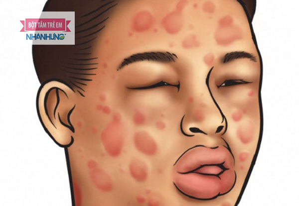 Nổi mề đay trên mặt gây phù mạch, sốc phản vệ… cần gặp bác sĩ ngay lập tức