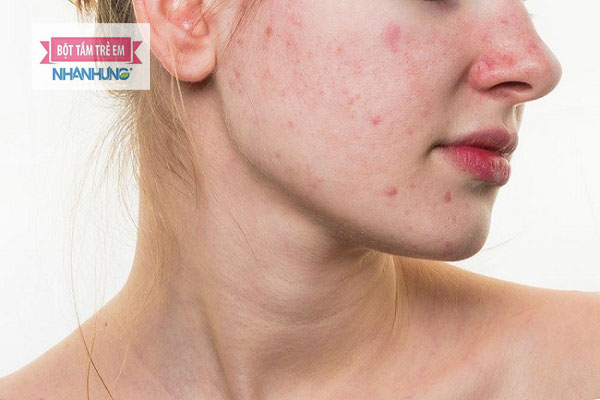 Nổi mề đay trên mặt do nhiều nguyên nhân khác nhau
