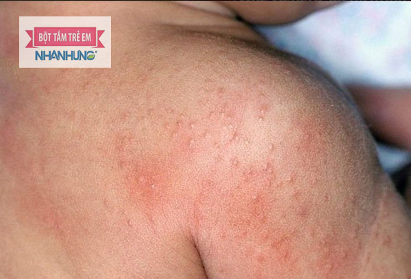 Rôm sảy ở trẻ có thể hết sau vài ngày sử dụng Bột tắm Nhân Hưng