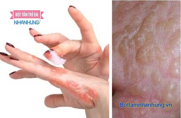 Kem dưỡng ẩm có tác dụng làm mềm da, kiểm soát cơn ngứa