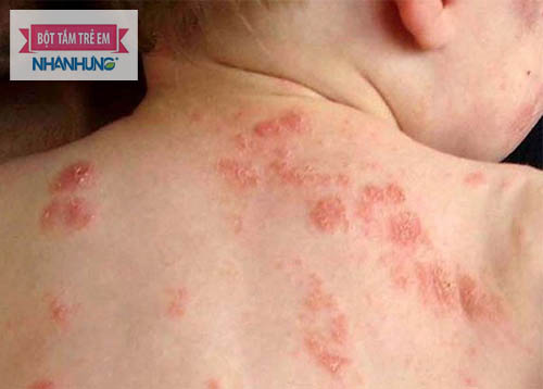 Nghiên cứu chỉ ra tác dụng tuyệt vời của Berberine với bệnh lý viêm da tiếp xúc dị ứng