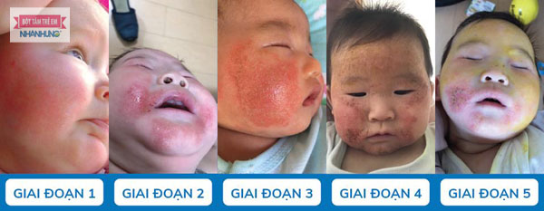 Biểu hiện và các giai đoạn của bệnh chàm sữa