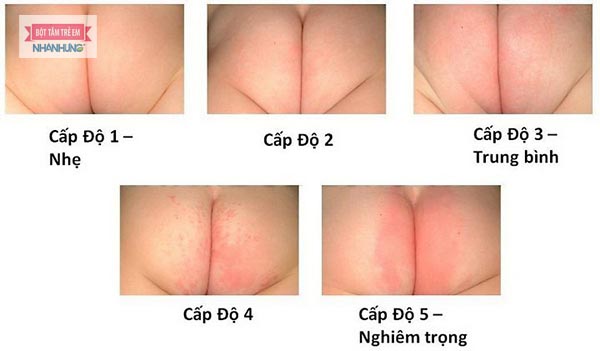 Các mức độ hăm tã ở trẻ ( ảnh : internet )