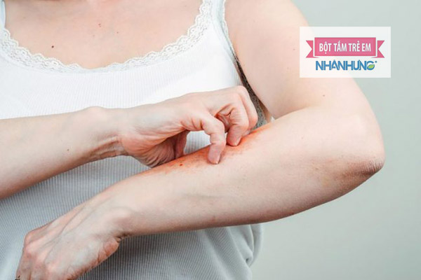 Người bệnh cần giữ cơ thể sạch sẽ, đồng thời hạn chế gãi ngứa khi bị nổi mề đay
