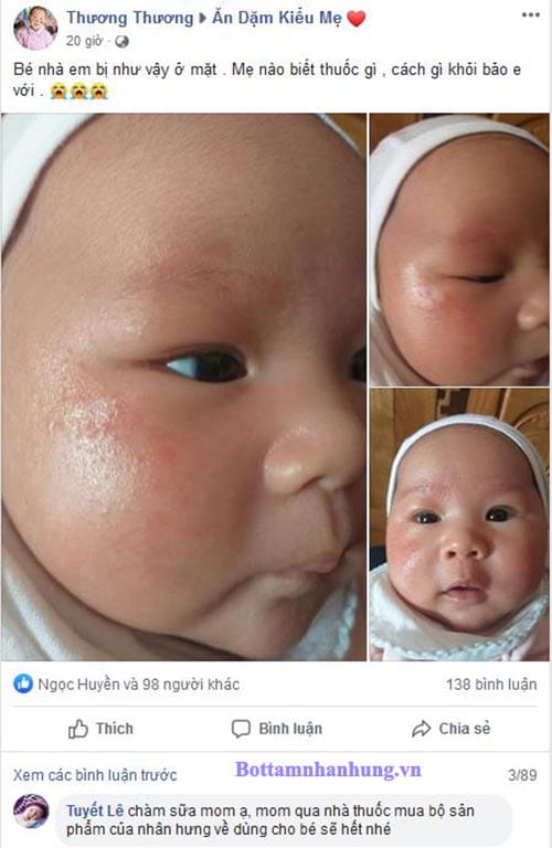 Bé bị chàm sữa khi thay đổi thời tiết làm cha mẹ lo lắng