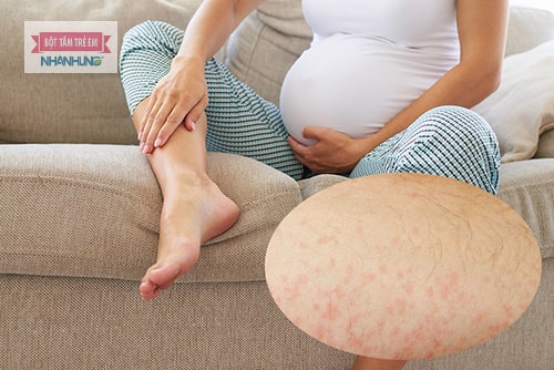 Bà bầu bị nổi mẩn ngứa ở chân là bệnh gì?