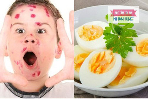Trứng nên được ăn với những loại thực phẩm nào để tối ưu hóa hiệu quả điều trị cho người bệnh thủy đậu? 
