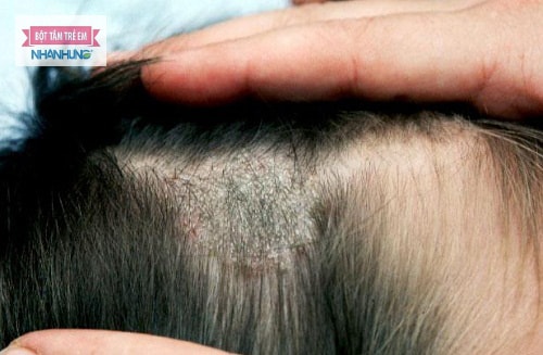 Nguyên nhân và cách điều trị viêm da đầu gây rụng tóc