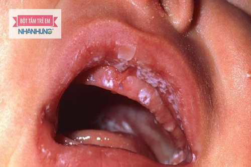 Nguyên nhân và cách xử lý bé bị đẹn lưỡi, nướu, miệng