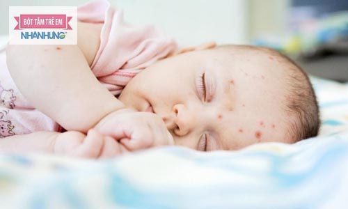 Trẻ sơ sinh bị mụn mủ ở đầu chữa thế nào cho an toàn?