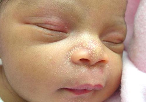 Mụn sữa ở trẻ sơ sinh: Nguyên nhân, nguy cơ và cách trị an toàn nhất