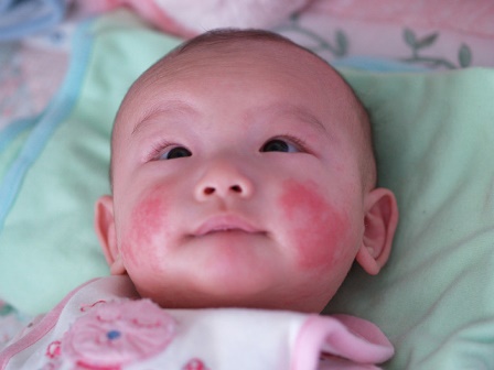 Đặc trưng của chàm sữa là mẩn đỏ, xuất hiện mụn li ti và ngứa ở hai má