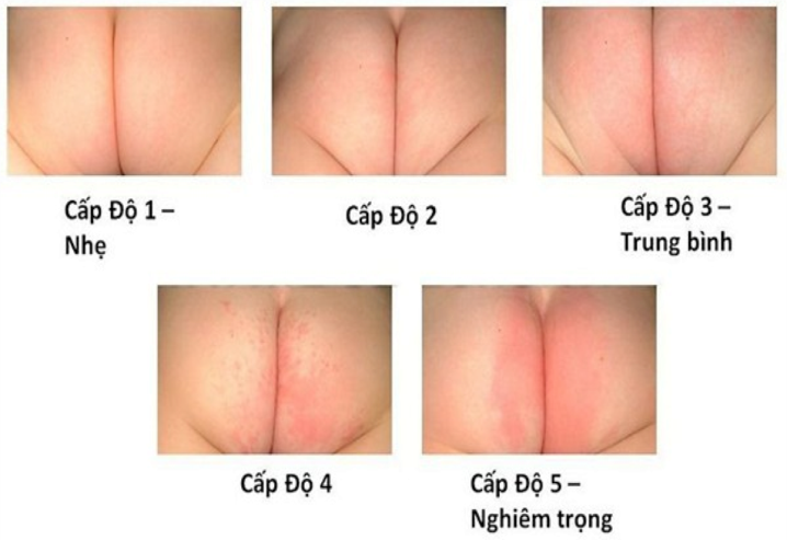 5 cấp độ điển hình của hăm tã ở trẻ em