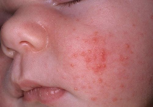 Mẩn ngứa ở trẻ đơn giản nhưng cần theo dõi liên tục