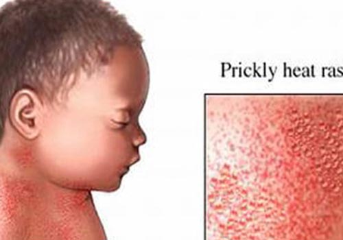 Rôm sảy có nhiều dạng với mức độ nặng nhẹ khác nhau