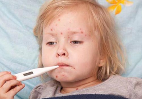 Tiêm phòng cho trẻ sơ sinh để phòng ngừa bệnh sởi