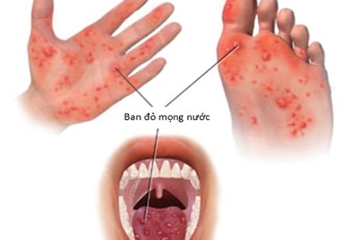 Bệnh tay, chân, miệng mối nguy cho sức khoẻ của trẻ sơ sinh 