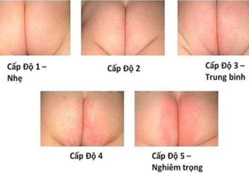 Có 5 cấp độ hăm da ở trẻ 