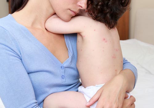 mụn nhọt mọc nhiều trên lưng trẻ sơ sinh và trẻ nhỏ