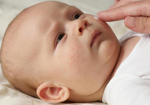 kem bôi trị mụn nhọt tiềm ẩn nguy cơ nhiễm trùng nếu không dõ nguồn gốc và chỉ định của bác sĩ