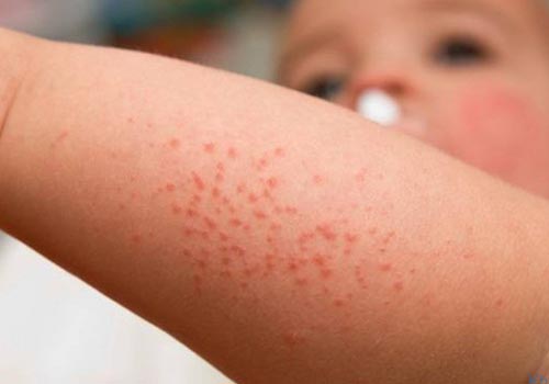 Rôm sảy mùa nắng nóng xuất hiện nhiều ở cánh tay