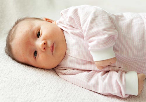 rôm sảy trêm mặt bé mùa nắng nóng làm bé ngứa ngáy khó chịu
