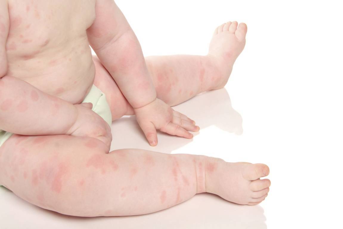 Mẹ làm gì khi bé bị mẩn ngứa - Bé bị mẩn ngứa khắp người