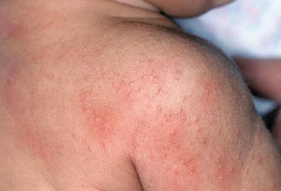Mùa hè là thời điểm trẻ bị rôm sảy nhiều nhất