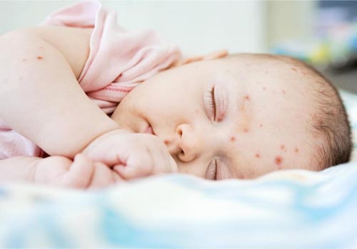 Trẻ thường xuyên bị mụn nhọt các mẹ cần tìn hiểu kỹ nguyên nhân do đâu: chế độ ăn, mặc, và mỗi trường sinh hoạt của bé