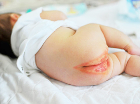 Ngày càng nhiều trẻ bị hăm tã