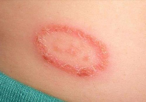 Hắc lào rất dễ gặp ở trẻ nếu vệ sinh không cẩn thận