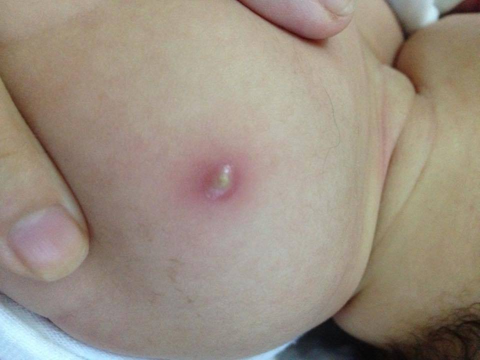 Mụn nhọt có thể mọc bất kỳ vị trí nào trên da bé đặc biệt những khu vực đổ nhiều mồ hôi và tiếp xúc với môi trường ô nhiễm bên ngoài