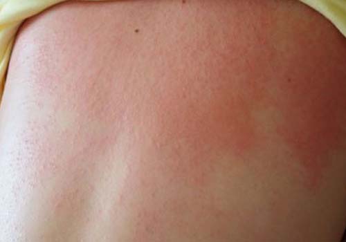Trường hợp bé bị Rôm sảy – con đường ngắn nhất dẫn đến mụn nhọt và viêm da