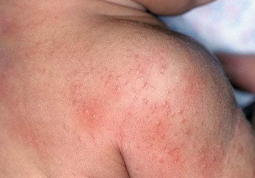 Chớ coi thường khi trẻ mọc rôm sảy