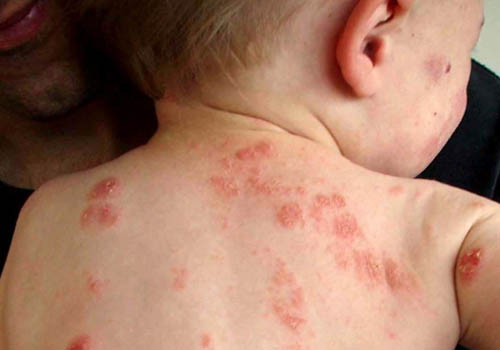 Bệnh zona gây ra nhiều khó chịu và đau đớn cho trẻ