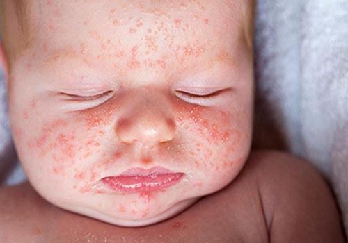 Làn da bé vô cùng nhạy cảm nên rất dễ bị dị ứng nổi mẩn đỏ gây ngứa