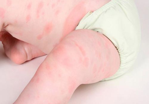 mẩn ngứa ở trẻ em lại gây ra khá nhiều bất tiện và sự khó chịu ở trẻ